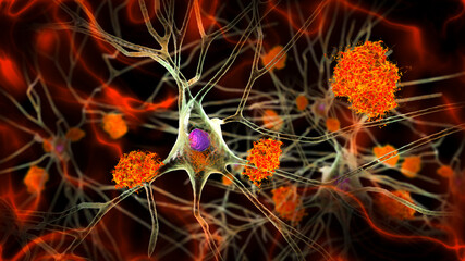 Neurons in Alzheimer's disease - obrazy, fototapety, plakaty