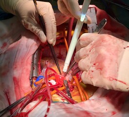 Surgeons was using aortic punch during Coronary Artery Bypass Grafting (CABG) surgery with...
