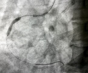 Drug eluting stent (DES) deployed at mid right coronary artery (RCA) during percutaneous coronary...