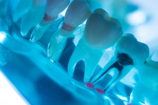Tooth decay