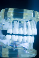 Dental tooth implant model