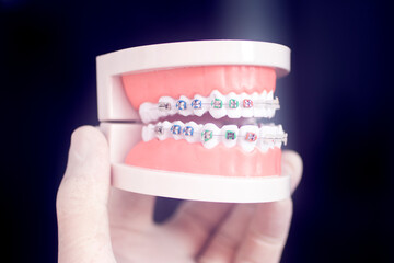 Dental teeth aligners brackets