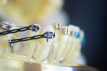 Dental teeth aligners brackets