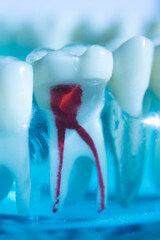 Tooth decay