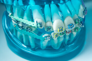 Metal teeth brackets