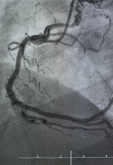 Coronary angiogram , medical x-ray for heart disease. Coronary artery disease.	