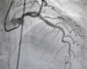 Coronary angiogram , medical x-ray for heart disease. Coronary artery disease.	