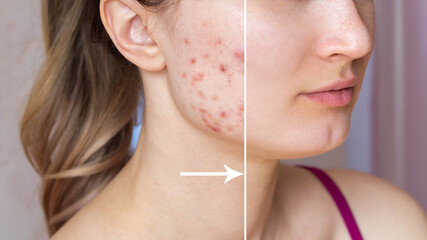 Cropped shot of a young woman's face before and after acne  treatment on face. Pimples, red scars...