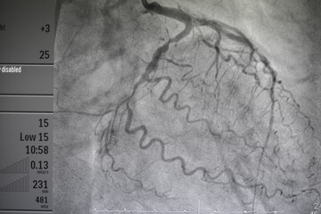Coronary angiogram , medical x-ray for heart disease. Coronary artery disease.	