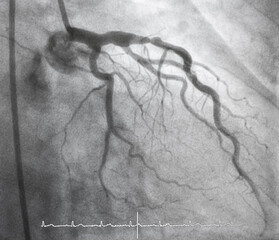 Coronary angiogram , medical x-ray for heart disease. Coronary artery disease.	