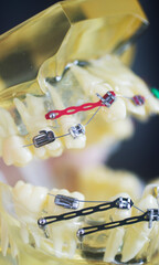 Dental teeth aligners brackets
