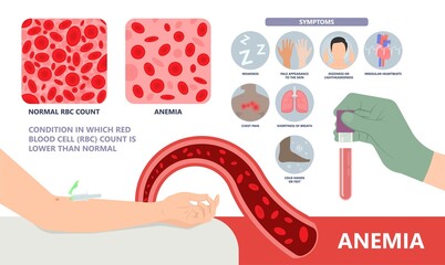 Iron infusion for anemia IV treat level red blood cells RBC loss low supplement