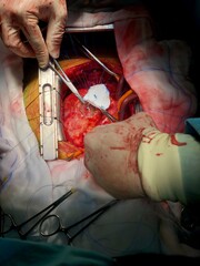 Surgeon used dacron patch for closure of Ventricular septal rupture (VSR) in acute myocardial...