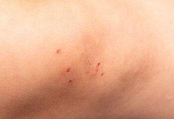 Fototapeta premium small scratches on the skin with a bruise