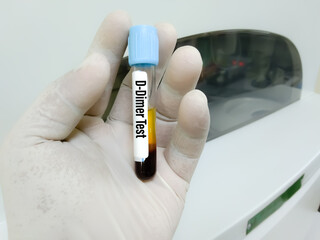 D-Dimer,FDP test. Corona patient monitoring test in ICU. Doctor, scientist hold a blood sample for...