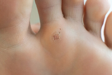 wart on a blunt close-up. Macro shot of human papilloma on the foot. - obrazy, fototapety, plakaty