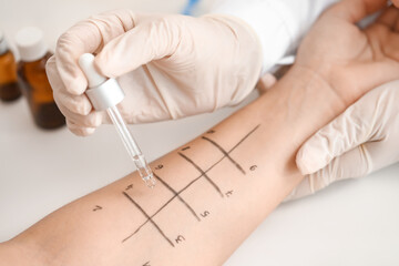 Young woman undergoing procedure of allergen skin tests in clinic