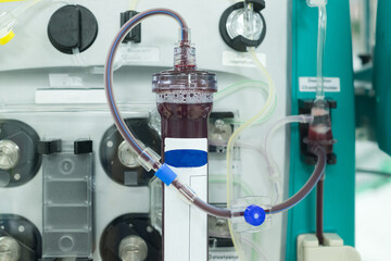  Hemodialysis machine (or hemofiltration procedure). Equipment for kidney failure in intensive care unit