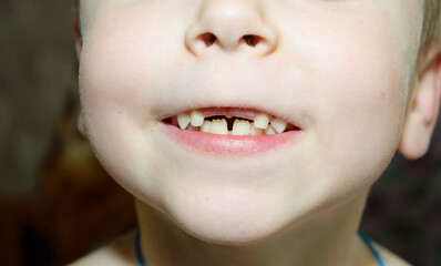 close-up - missing teeth from the upper jaw of a child © Елена 