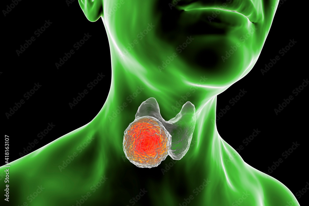 Poster Thyroid cancer in women