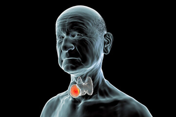 Thyroid cancer, illustration