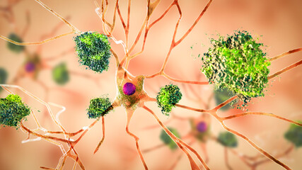 Neurons in Alzheimer's disease
