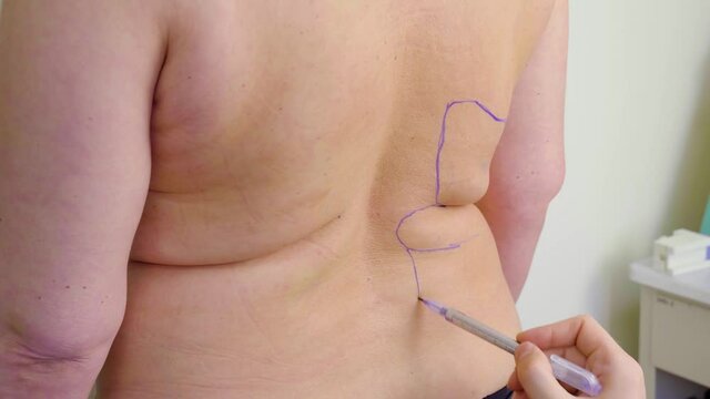 Abdominoplasty markup before plastic operation to reduce the abdomen and remove cellulite. Correcting body shape. Surgeon paint lines on body of woman