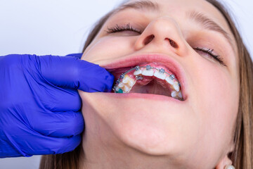  Girl with braces and elastic rubber. Orthodontist treatment.