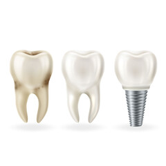 Realistic healthy tooth,tooth with caries and dental implant with screw. Vector illustratio