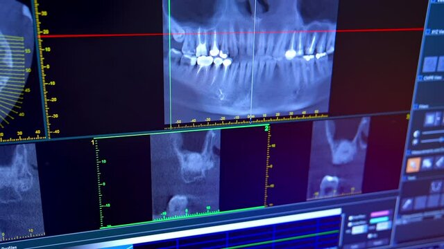 X-ray of oral cavity with teeth. Close up of digital orthopantomography for dental diagnosis