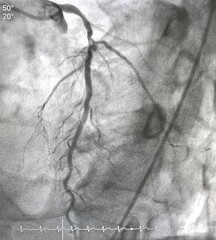 Coronary angiogram shown left anterior descending artery (LAD) stenosis with coronary aneurysm during cardiac catheterization.