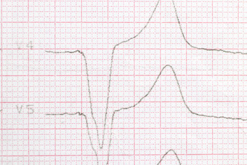Macro photo of ECG cardiogram of a patient with a heart attack.