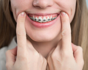Close-up of a young woman's smile with metal braces on her teeth. Correction of bite
