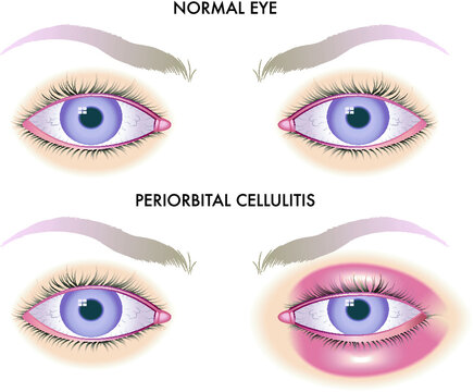 Medical Illustration Shows The Comparison Between Normal Eyes And Those Affected By Periorbital Cellulitis. 