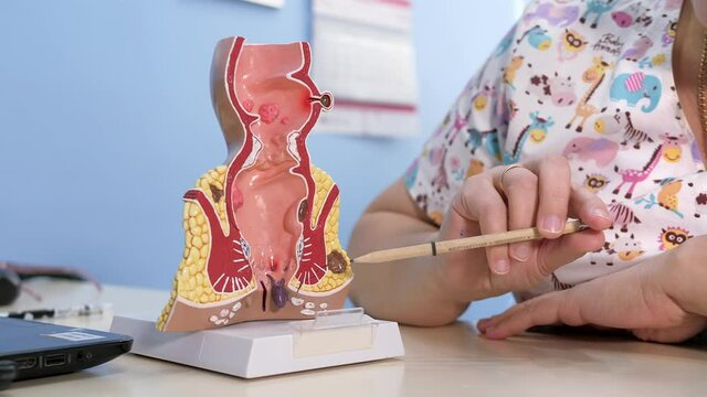 Proctologist points out the pathology of the rectum with a pencil to the anatomical model.