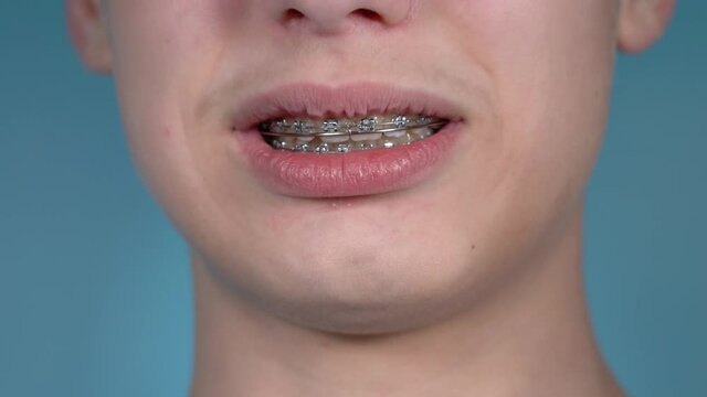 Close up view 4k stock video footage of smiling mouth of young white teenage kid with overbite teeth and metal modern braces construction on them