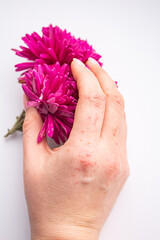 A woman's hand with papyloms from the virus holds a bud of pink chrysanthemums