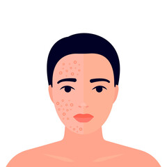 Woman before and after acne on skin face treatment. Half face inflamation skin, spot and pimple, half face normal skin. Dermatology, cosmetology problem. Skin care, higiene, clean. Vector illustration