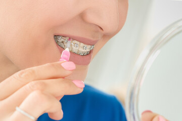 Wearing orthodontal dental brackets device mounted on woman face smile in order to align teeth