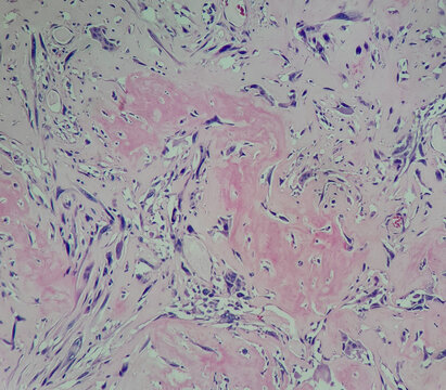 Photo of osteosarcoma in the breast, magnification 200x, photo under microscope