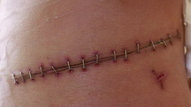 Surgical scars that are sutured with metal