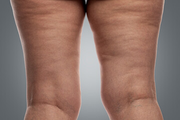 Women's legs with a problem of excess weight and cellulite. Back view. Close-up. Grey background. Close-up.