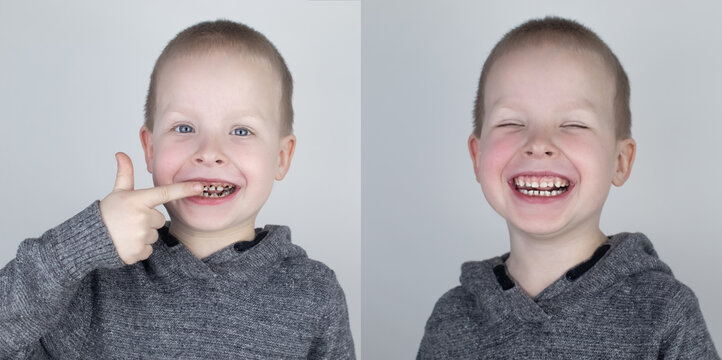 Before and after. The child shows the damaged teeth by caries, and in the second picture the dentist's work on the restoration of teeth. Children's caries, treatment, recovery