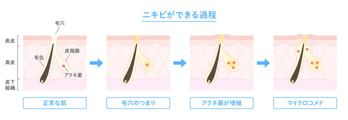 肌断面図で見せるニキビができる過程のイラスト