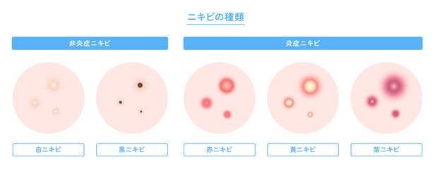 肌にできたニキビの種類のイラスト