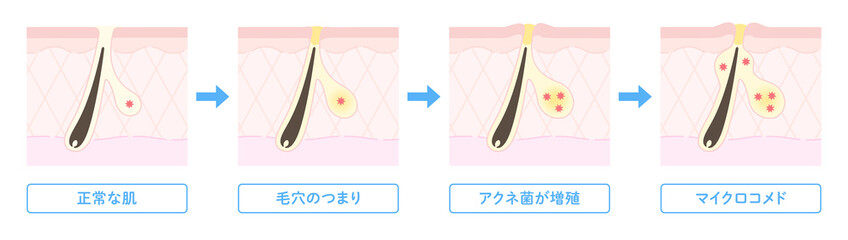 肌断面図で見せるニキビができる過程のイラスト