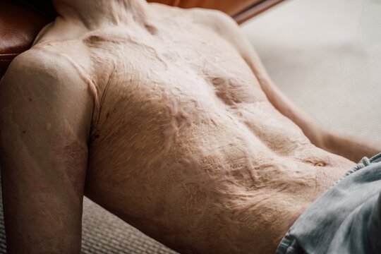 Man with a large scar after burn on the body laying at the floor and relaxing