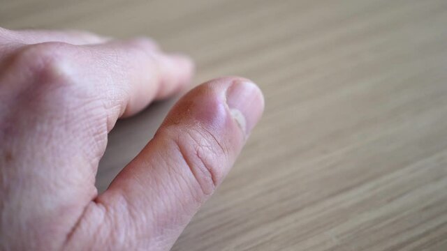 Paronychia Finger Nail Infection and Black Sulfur Ointment