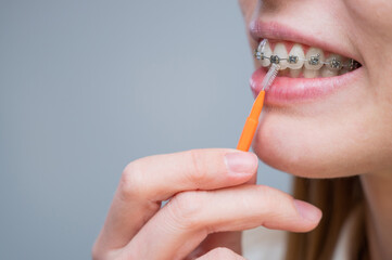 Unrecognizable Caucasian woman cleans braces with a brush. Close-up of female teeth with brackets