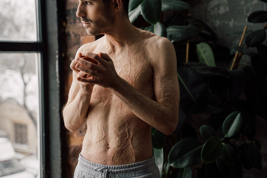 Man with scars at the skin after burn looking at the window and drinking tea
